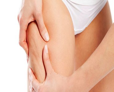 Warum Frauen häufiger zu Cellulite neigen + 5 tolle Hausmittel